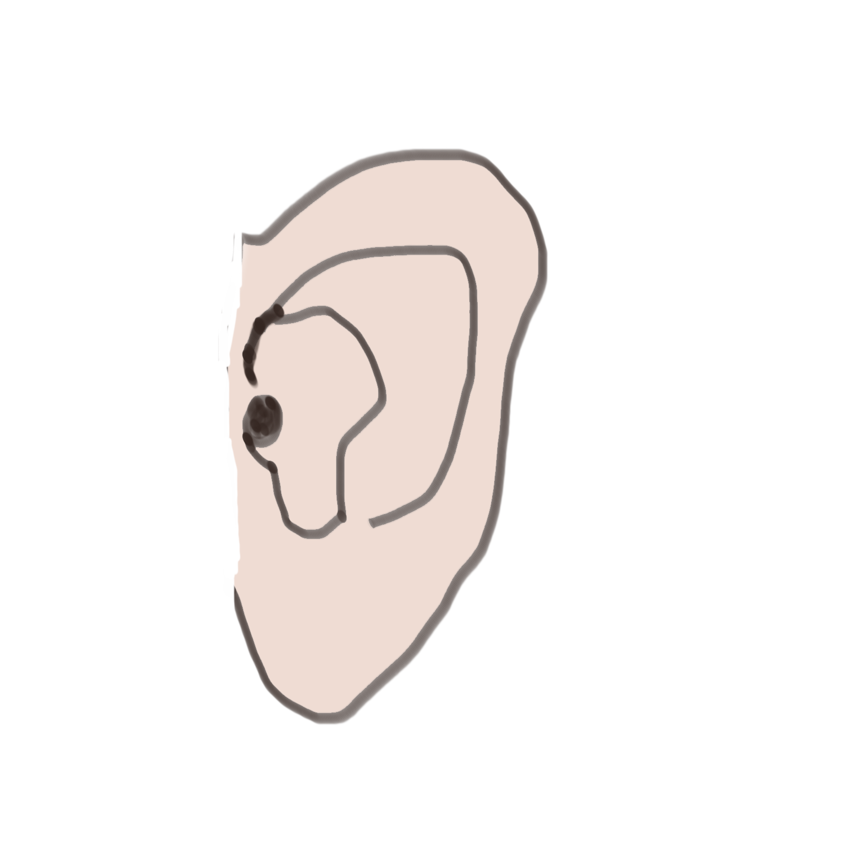 耳鳴り難聴に対する鍼灸治療のイラスト
